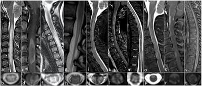 Update in autoimmune and paraneoplastic myelopathies: Newly described antigen targets and antibody testing